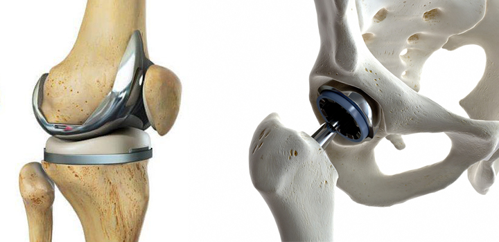 Joint Replacements